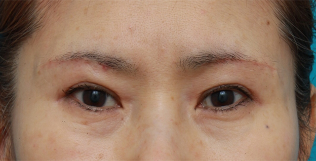 眉下リフト（上眼瞼リフト）,眉下リフト（上眼瞼リフト）の症例写真,1週間後,mainpic_tarumi04c.jpg