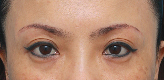眉下リフト（上眼瞼リフト）,眉下リフト（上眼瞼リフト）で目を大きくして二重の幅を広げた中国人女性の症例写真の術前術後画像,After（6ヶ月後）,ba_jougankenlift03_b.jpg