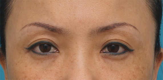 症例写真,眉下リフト（上眼瞼リフト）で目を大きくして二重の幅を広げた中国人女性の症例写真の術前術後画像,Before,ba_jougankenlift03_b.jpg