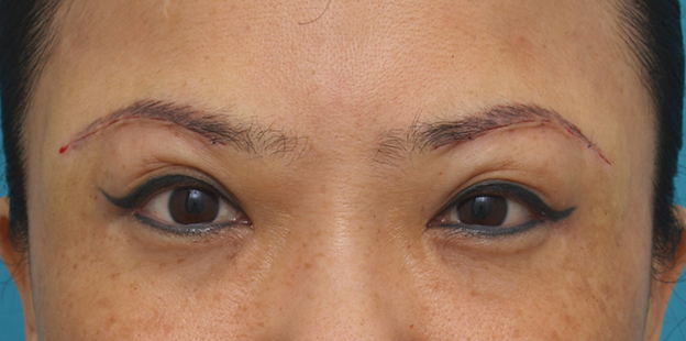 眉下リフト（上眼瞼リフト）,眉下リフト（上眼瞼リフト）で目を大きくして二重の幅を広げた中国人女性の症例写真の術前術後画像,手術直後,mainpic_jougankenlift02b.jpg