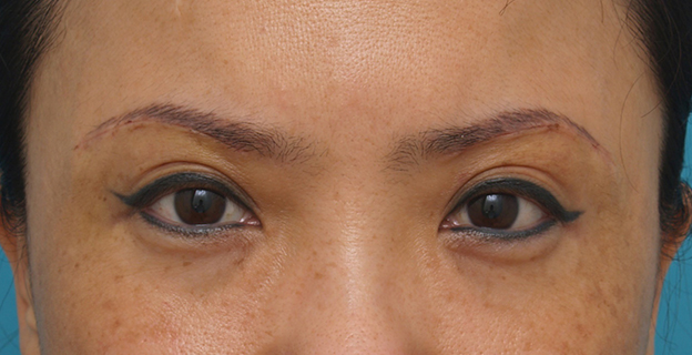眉下リフト（上眼瞼リフト）,眉下リフト（上眼瞼リフト）で目を大きくして二重の幅を広げた中国人女性の症例写真の術前術後画像,1週間後,mainpic_jougankenlift02c.jpg