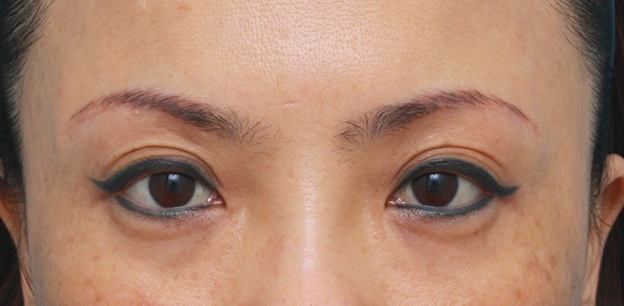 眉下リフト（上眼瞼リフト）,眉下リフト（上眼瞼リフト）で目を大きくして二重の幅を広げた中国人女性の症例写真の術前術後画像,6ヶ月後,mainpic_jougankenlift02d.jpg