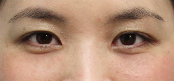 目の下のクマ治療,目の下の脂肪取りの症例 目の下のクマ治療のため脂肪を取った30代女性,After（1週間後）,ba_shibo04_b.jpg