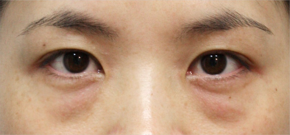 目の下の脂肪取り,目の下のクマ治療,目の下の脂肪取りの症例 目の下のクマ治療のため脂肪を取った30代女性,Before,ba_shibo04_b.jpg