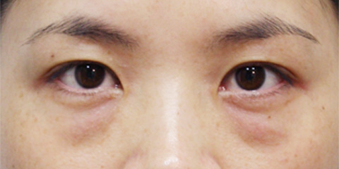 目の下のクマ治療,目の下の脂肪取りの症例 目の下のクマ治療のため脂肪を取った30代女性,施術前,mainpic_shibo01a.jpg