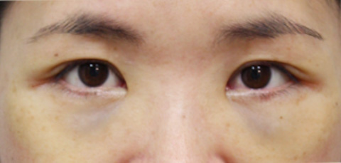 目の下のクマ治療,目の下の脂肪取りの症例 目の下のクマ治療のため脂肪を取った30代女性,施術直後,mainpic_shibo01b.jpg