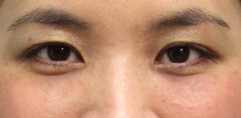症例写真,目の下の脂肪取りの症例 目の下のクマ治療のため脂肪を取った30代女性,1週間後,mainpic_shibo01c.jpg