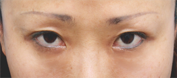 目の下の脂肪取り,目の下のクマ治療,目の下の脂肪取りの症例 たるみが陰になりクマのように見えていた40代女性,After,ba_shibo06_a01.jpg