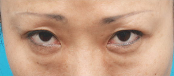 症例写真,目の下の脂肪取りの症例 たるみが陰になりクマのように見えていた40代女性,Before,ba_shibo06_b.jpg