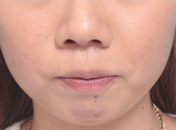 唇を薄く（口唇縮小術）,タラコ唇の人に、手術で上下の唇を薄くした症例写真,After（10日後）,ba_usuku12_a01.jpg