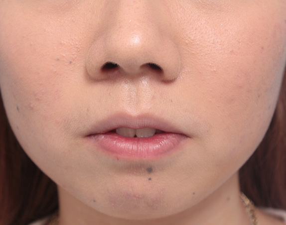 唇を薄く（口唇縮小術）,タラコ唇の人に、手術で上下の唇を薄くした症例写真,After（10日後）,ba_usuku13_b.jpg