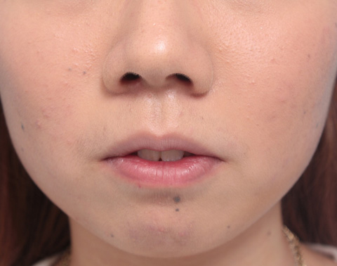 唇を薄く（口唇縮小術）,タラコ唇の人に、手術で上下の唇を薄くした症例写真,10日後,mainpic_usuku02c.jpg