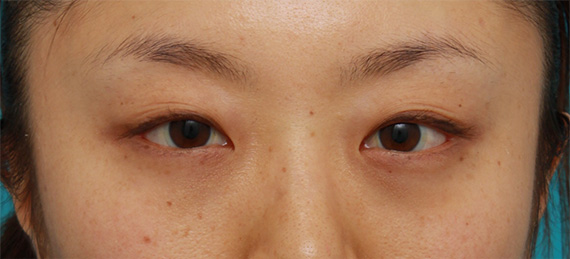 目の下のクマ治療,目の下の脂肪取り症例写真,After（1ヶ月後）,ba_shibo08_b.jpg