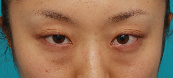 目の下のクマ治療,目の下の脂肪取り症例写真,Before,ba_shibo08_b.jpg