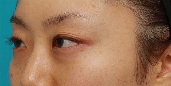 目の下のクマ治療,目の下の脂肪取り症例写真,After（1ヶ月後）,ba_shibo09_b.jpg