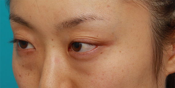 目の下のクマ治療,目の下の脂肪取り症例写真,Before,ba_shibo09_b.jpg