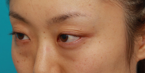 目の下の脂肪取り,目の下の脂肪取り症例写真,施術前,mainpic_shibo02b.jpg