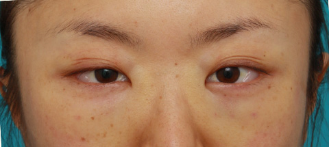 目の下のクマ治療,目の下の脂肪取り症例写真,施術直後,mainpic_shibo03a.jpg