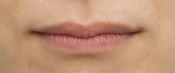 唇を薄く（口唇縮小術）,唇を薄く（口唇縮小術）の症例 上唇、下唇をそれぞれ薄くした30代女性,After,ba_usuku07_a01.jpg