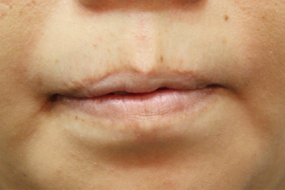 唇を薄く（口唇縮小術）,唇を薄く（口唇縮小術）の症例 上唇、下唇を薄くされた40代女性,After,ba_usuku08_a01.jpg