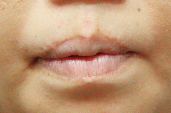 唇を薄く（口唇縮小術）,唇を薄く（口唇縮小術）の症例 上唇、下唇を薄くされた40代女性,Before,ba_usuku08_b.jpg