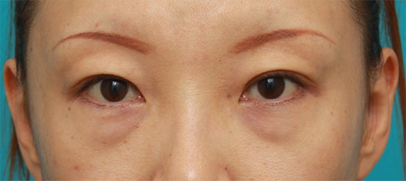 目の下のクマ治療,目の下のクマに対して脂肪除去をした症例写真,Before,ba_tarumi19a_b.jpg
