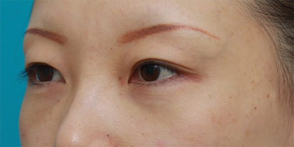 目の下のクマ治療,目の下のクマに対して脂肪除去をした症例写真,After（メイクなし）,ba_tarumi19b_b.jpg
