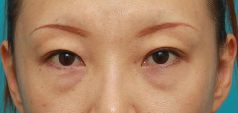 目の下のクマ治療,目の下のクマに対して脂肪除去をした症例写真,施術前,mainpic_tarumi1a.jpg