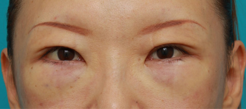 目の下のクマ治療,目の下のクマに対して脂肪除去をした症例写真,施術直後,mainpic_tarumi1b.jpg