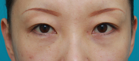 目の下のクマ治療,目の下のクマに対して脂肪除去をした症例写真,1ヶ月後,メイクなし,mainpic_tarumi1c.jpg
