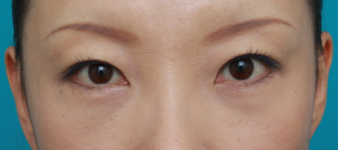 目の下のクマ治療,目の下のクマに対して脂肪除去をした症例写真,1ヶ月後,メイクあり,mainpic_tarumi1d.jpg