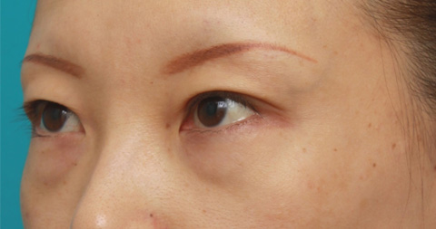 目の下のクマ治療,目の下のクマに対して脂肪除去をした症例写真,施術前,mainpic_tarumi1e.jpg