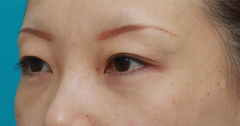 目の下のクマ治療,目の下のクマに対して脂肪除去をした症例写真,1ヶ月後,メイクなし,mainpic_tarumi1g.jpg