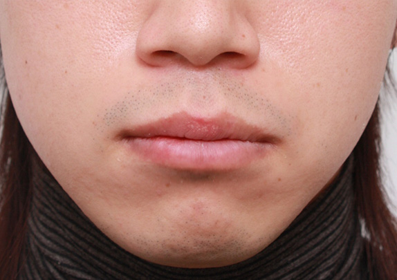 唇を薄く（口唇縮小術）,くちびる薄くする手術の症例写真,After（10日後）,ba_usuku10_a01.jpg