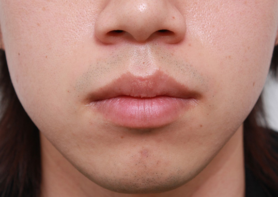 唇を薄く（口唇縮小術）,くちびる薄くする手術の症例写真,Before,ba_usuku10_b.jpg