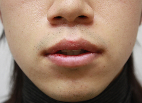 唇を薄く（口唇縮小術）,くちびる薄くする手術の症例写真,After（10日後）,ba_usuku11_b.jpg