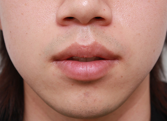 唇を薄く（口唇縮小術）,くちびる薄くする手術の症例写真,Before,ba_usuku11_b.jpg
