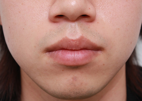 唇を薄く（口唇縮小術）,くちびる薄くする手術の症例写真,手術前,mainpic_usuku01a.jpg