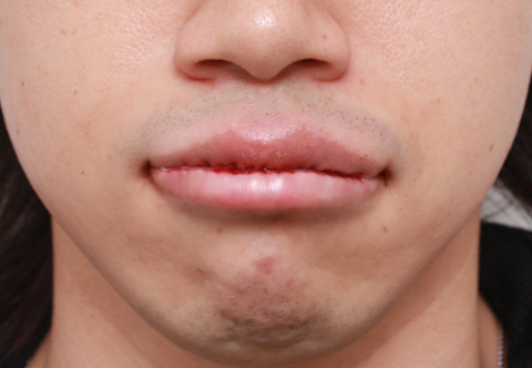 唇を薄く（口唇縮小術）,くちびる薄くする手術の症例写真,手術直後,mainpic_usuku01b.jpg