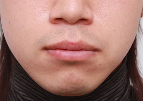 唇を薄く（口唇縮小術）,くちびる薄くする手術の症例写真,10日後,mainpic_usuku01c.jpg