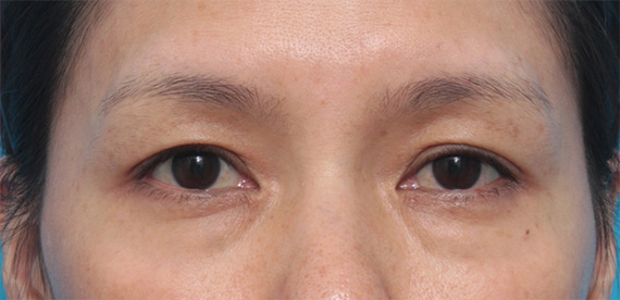目の下のクマ治療,目の下の脂肪取りをして、目の下のクマを改善させた症例写真,Before,ba_menositasibou01_b.jpg