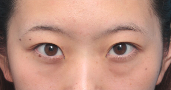 目の下の脂肪取り,目の下の脂肪を除去して、クマを目立たなくした症例写真,Before,ba_shibo10_b.jpg