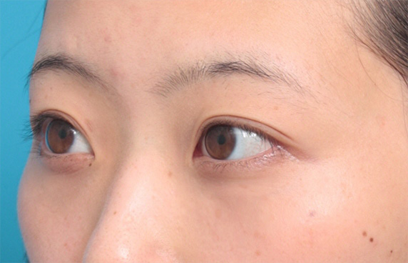 目の下の脂肪取り,目の下の脂肪を除去して、クマを目立たなくした症例写真,After（1ヶ月後）,ba_shibo11_b.jpg