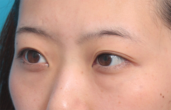 目の下の脂肪取り,目の下の脂肪を除去して、クマを目立たなくした症例写真,Before,ba_shibo11_b.jpg