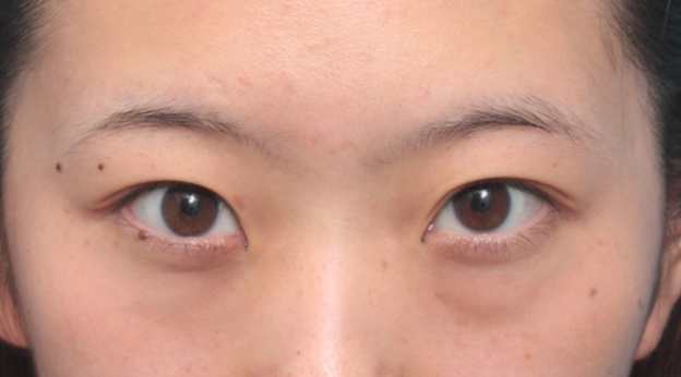 目の下のクマ治療,目の下の脂肪を除去して、クマを目立たなくした症例写真,手術前,mainpic_shibo05a.jpg