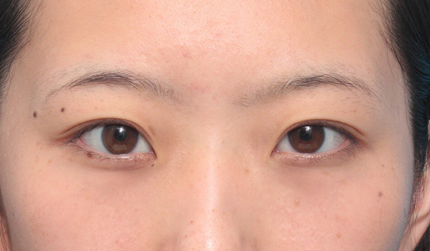 目の下の脂肪取り,目の下の脂肪を除去して、クマを目立たなくした症例写真,1ヶ月後,mainpic_shibo05c.jpg