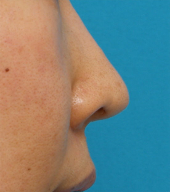 耳介軟骨移植（鼻先を出す）,耳介軟骨移植（鼻先を出す）の症例 鼻先が少し丸く厚みが気になる30代女性,After,ba_jikai11_b.jpg