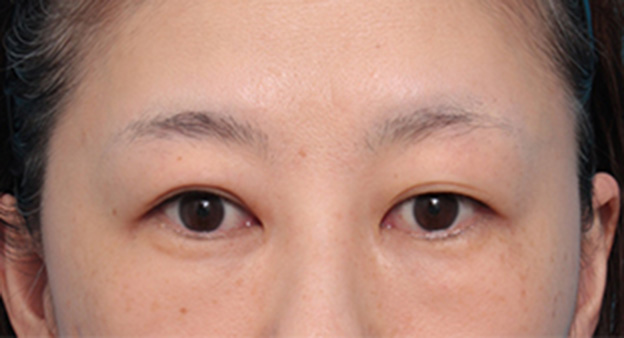 目の下の脂肪取り,目の下の脂肪を取り、埋もれていた涙袋が浮き出てきた症例写真の術前術後画像,手術前,mainpic_shibo06a.jpg