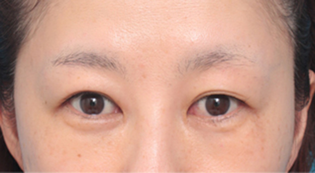 目の下の脂肪取り,目の下の脂肪を取り、埋もれていた涙袋が浮き出てきた症例写真の術前術後画像,2日後,mainpic_shibo06c.jpg