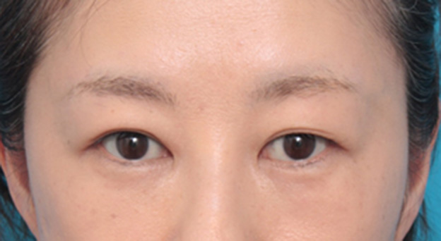 目の下の脂肪取り,目の下の脂肪を取り、埋もれていた涙袋が浮き出てきた症例写真の術前術後画像,6ヶ月後,mainpic_shibo06d.jpg